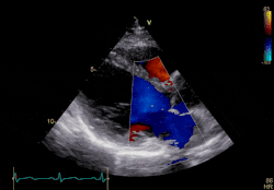 心臟超聲波掃瞄影像