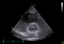 心臟超聲波掃瞄影像